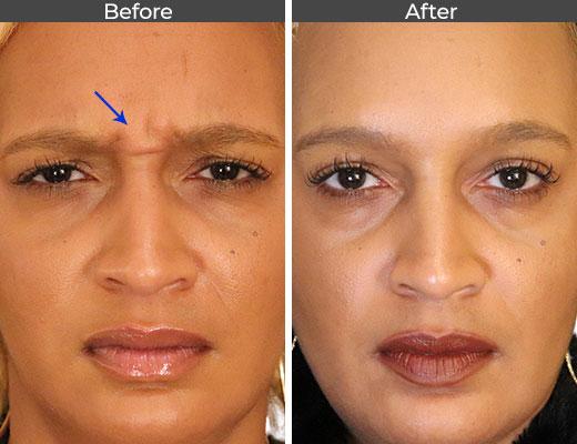 Botox-6.jpg